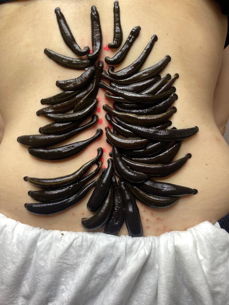 HIRUDOTHERAPY AS A SYSTEMIC TREATMENT METHOD DEVELOPED BY DR NERON NAM: BIOLOGICAL PRINCIPLES AND CLINICAL APPLICATION
